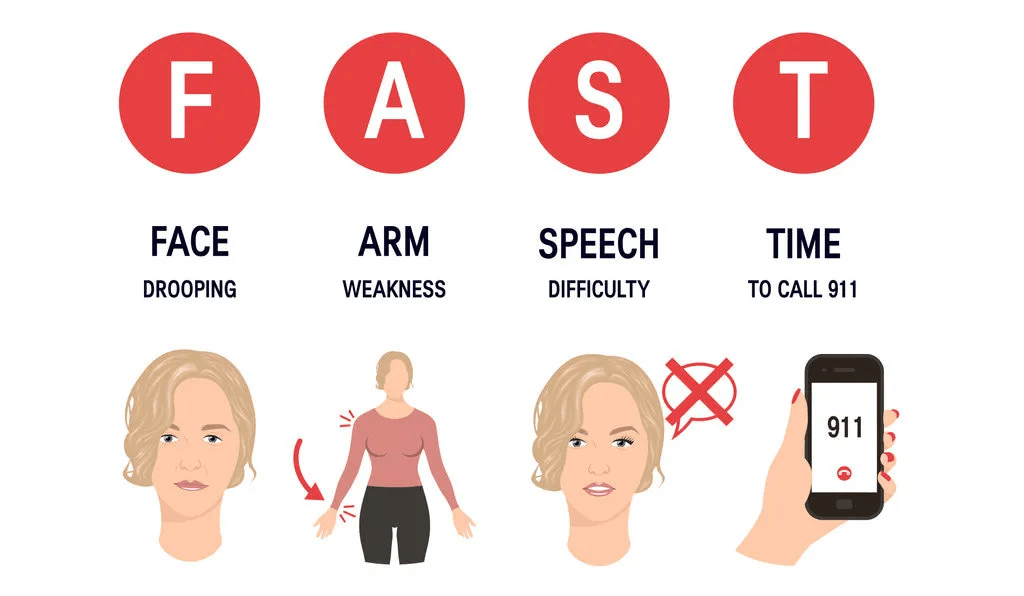 FAST là quy tắc nhận biết đột quỵ phổ biến mà bạn cần ghi nhớ